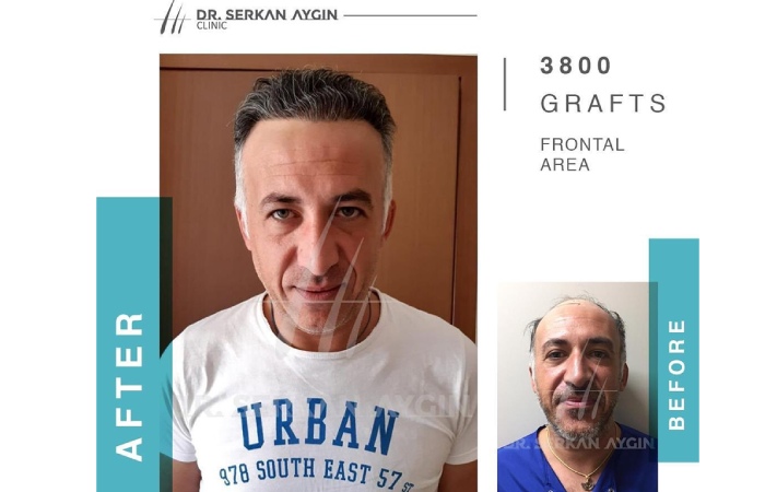 The Best Hair Transplant in Turkey - Dr Serkan Aygin Clinic 