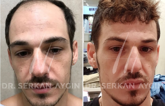 The Best Hair Transplant in Turkey - Dr Serkan Aygin Clinic 