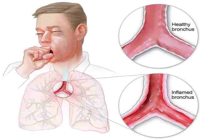 Treatment For Bronchitis